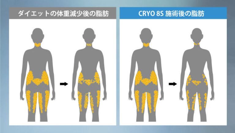 脂肪冷却,エステサロン,Dr.BODY Rose,ダイエット専門サロン,痩せる